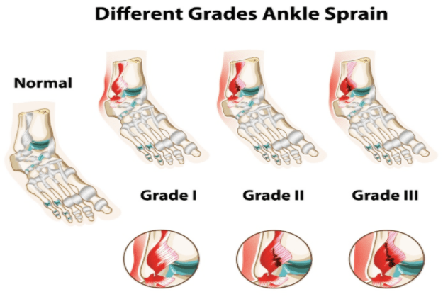 Grading of Ankle Sprain: