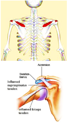 SUPRASPINATUS TENDINOPATHY - PHYSIOTHERAPY PERSPECTIVE