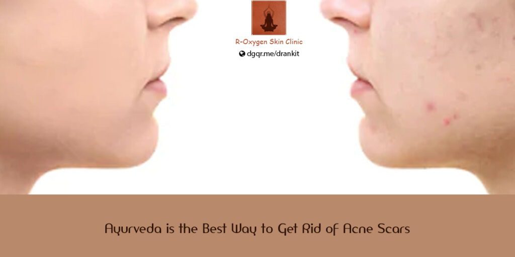 Ayurveda is the Best Way to Get Rid of Acne Scars