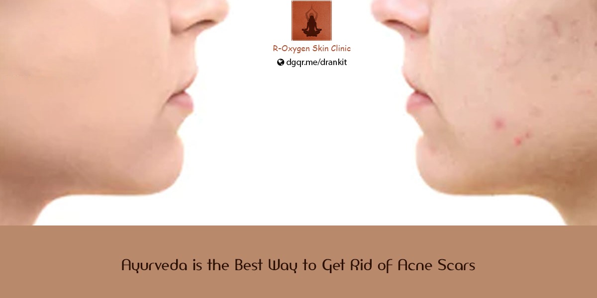 Ayurveda for Pimples & Acne Scars Blog by Ayurvedic Dermatologist