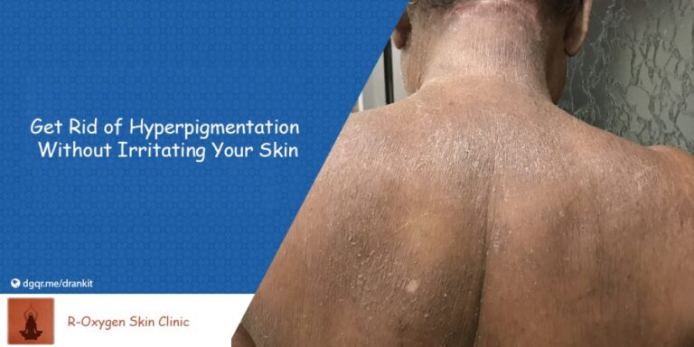 Hyperpigmentation: Causes, Symptoms, Treatments And More