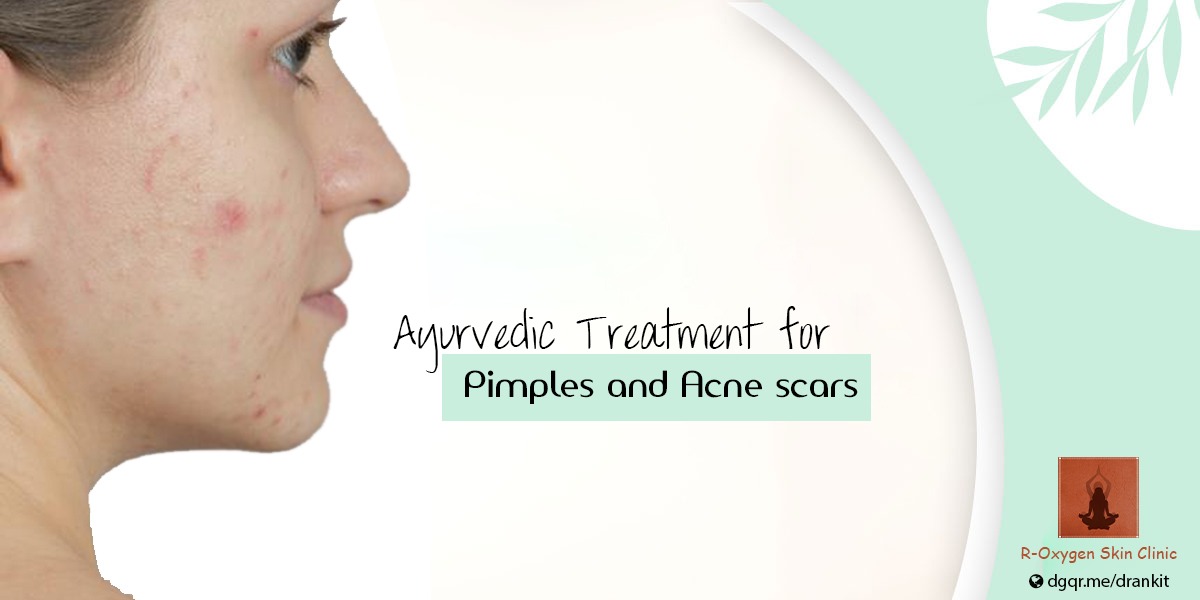 Ayurveda for Pimples & Acne Scars Blog by Ayurvedic Dermatologist