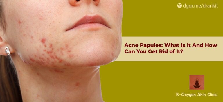 Acne Papules: What Is It And How Can You Get Rid of It?