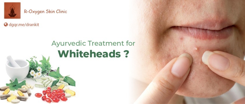 Whiteheads, skin care, skin treatment, Dr. Ankit Pandey, how to get rid of whiteheads, Whiteheads ayurvedic treatment, acne, acne ayurvedic treatment, ayurvedic treatment for pimples, cause of acne, Ayurvedic acne treatment, ayurvedic medicine for pimples and marks, ayurveda acne face map, ayurvedic treatments for whiteheads
