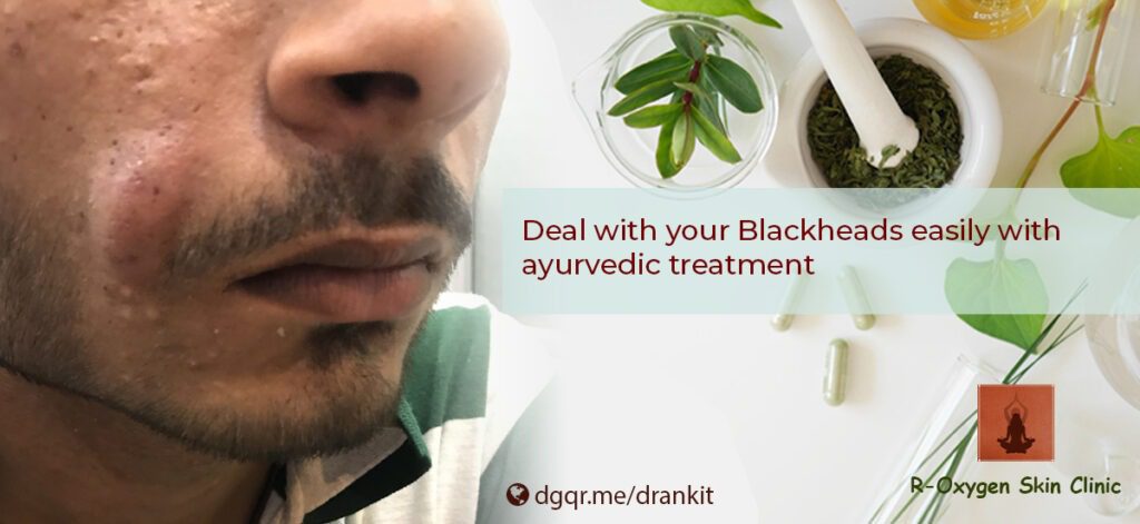 Blackheads-ayurvedic-treatment-Main