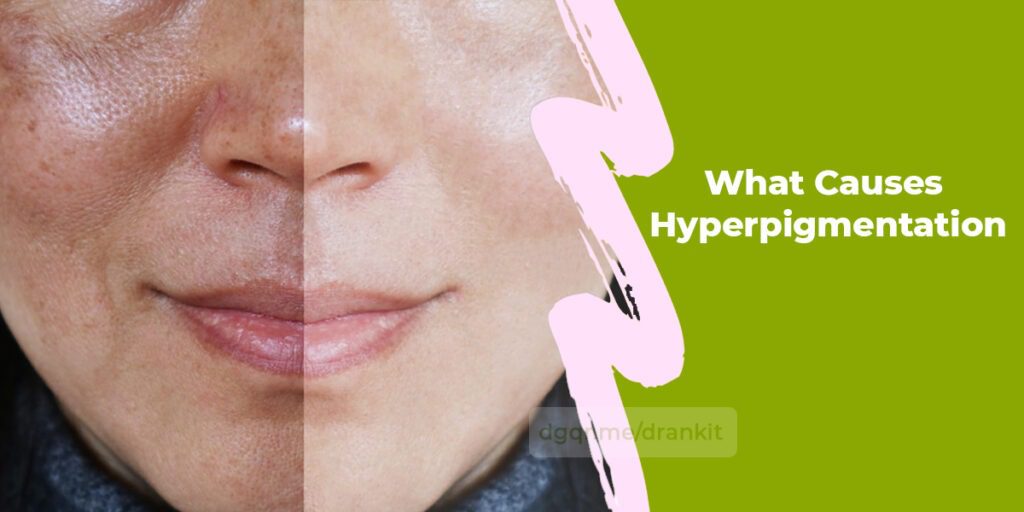 Causes-Hyperpigmentation